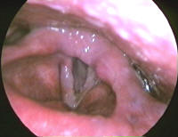 T1b Squamous Cell Carinoma of the True Vocal Cords